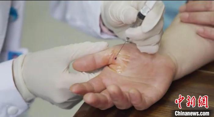 嘉善群眾體驗小針刀。 嘉善統戰 供圖